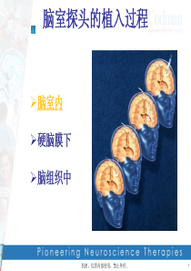 脑室探头的植入
